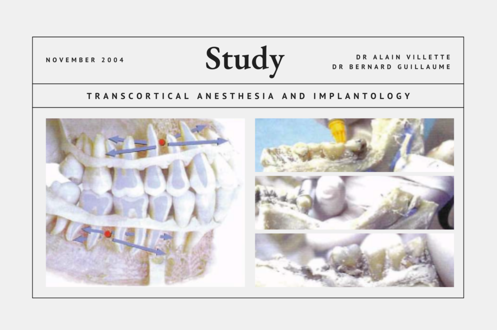 Transcortical Anesthesia and Implantology