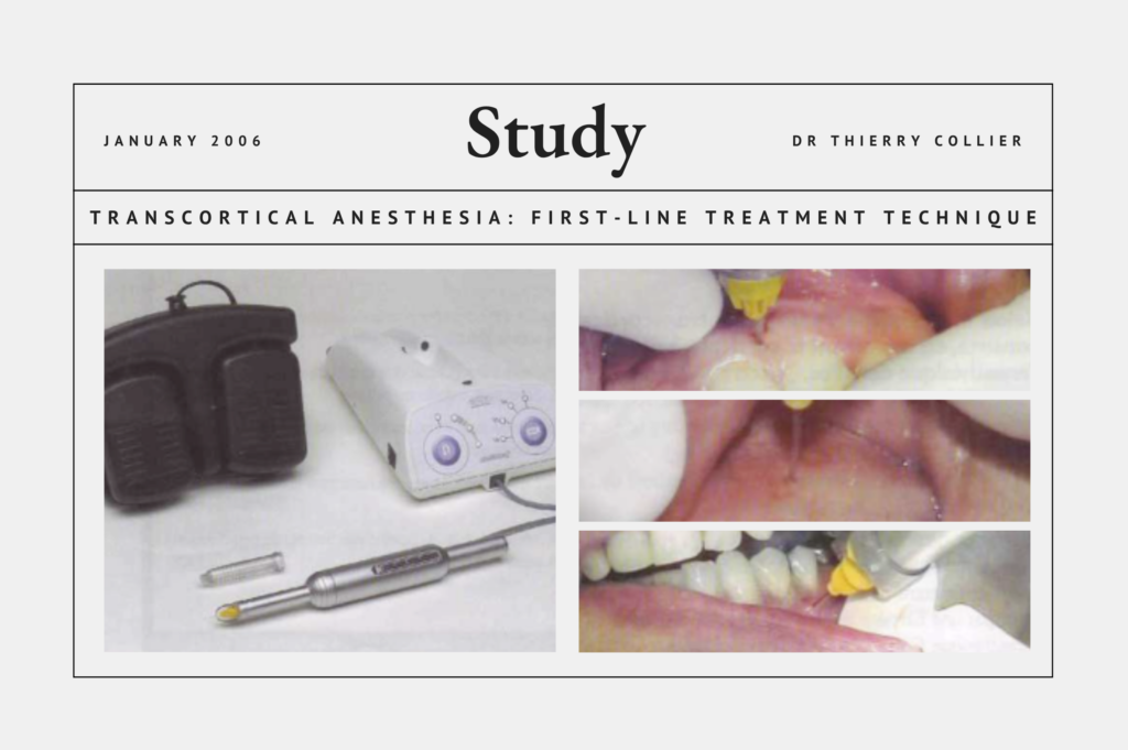 Transcortical Anesthesia: First-Line Treatment Technique