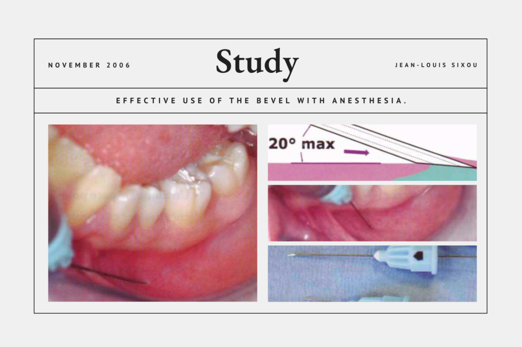 Effective Use of the Bevel with Anesthesia