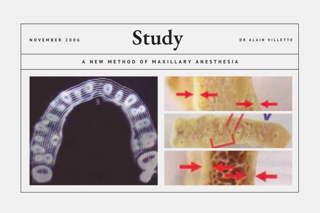 A New Method of Maxillary Anesthesia
