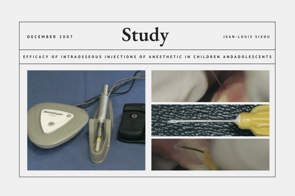 Efficacy of Intraosseous Injections of Anesthetic in Children and Adolescents
