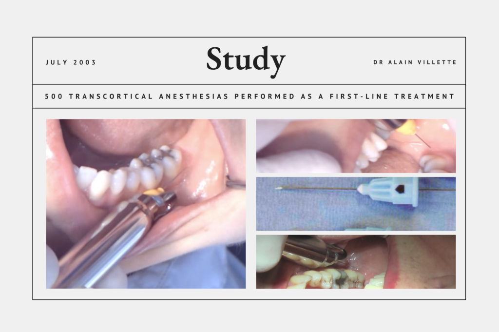 500 Transcortical Anesthesias Performed as a First-Line Treatment