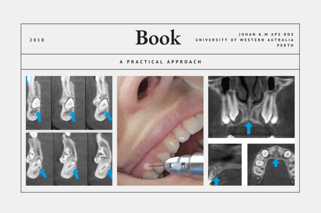 Intraosseous anesthesia with QuickSleeper – A Practical Approach